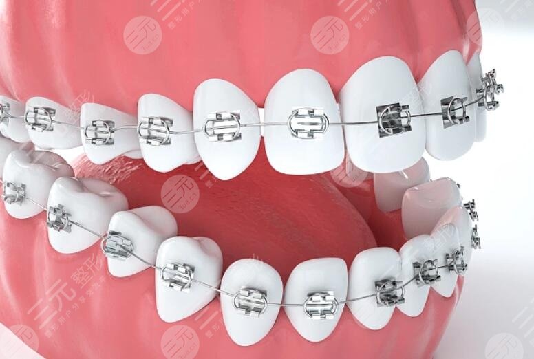 北京大學(xué)第三醫(yī)院牙齒正畸案例參考