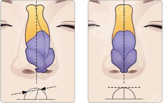 任天平醫(yī)生做鼻子怎么樣