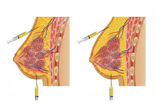 膠原豐胸可以保持多久
