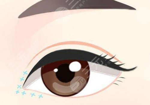 張家口維多利亞做開眼角手術(shù)怎么樣