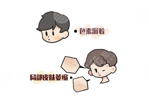 去色素沉著好的方法