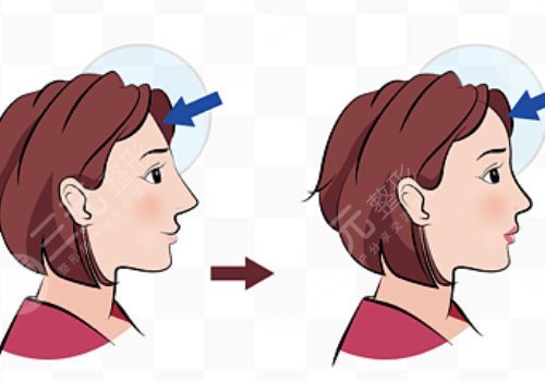 額頭填充一般維持多久