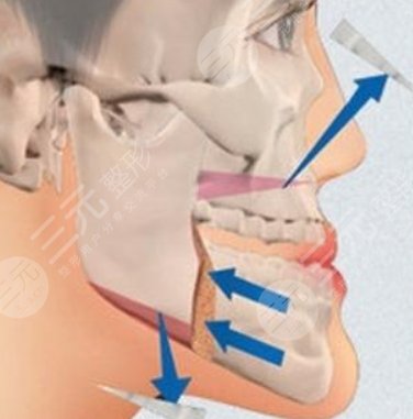 上海九院正頜手術(shù)費(fèi)用表