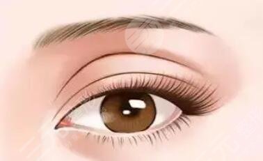 解讀！  小虎做雙眼皮案例