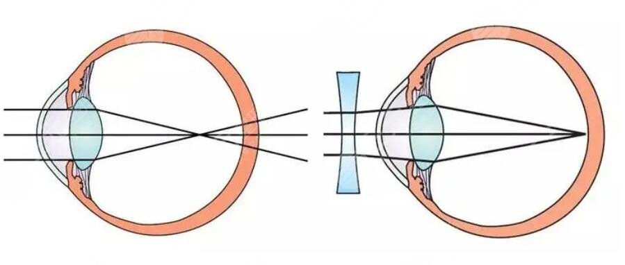 近視眼矯正