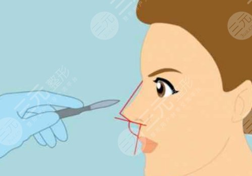 鄭州張海洋鼻整形案例