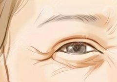 除眼角細(xì)紋的小妙招分享！2種醫(yī)美項(xiàng)目幫你搞定~