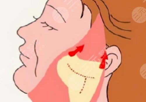 微創(chuàng)小切口拉皮恢復(fù)期多長時間