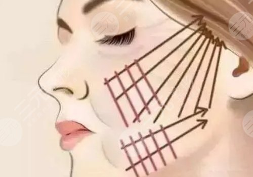 微創(chuàng)小切口拉皮恢復(fù)期多長時間