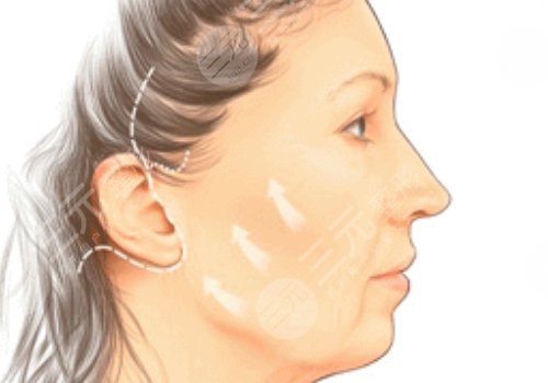 微創(chuàng)小切口拉皮恢復(fù)期多長時間