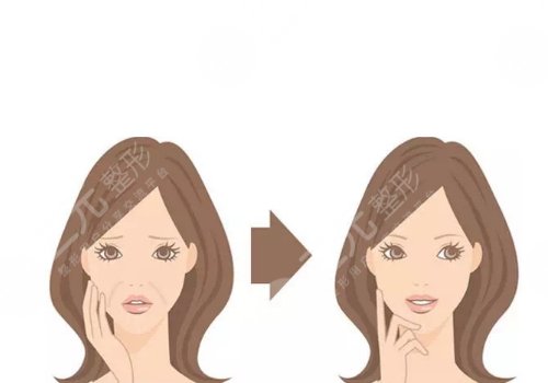 鼻唇溝太深怎么辦