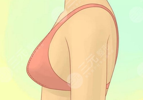 隆胸假體取出親身經(jīng)歷