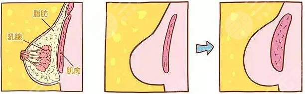 美國麥格假體隆胸會不會痛?