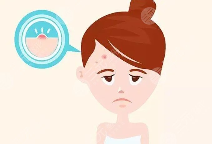 額頭長(zhǎng)痘痘