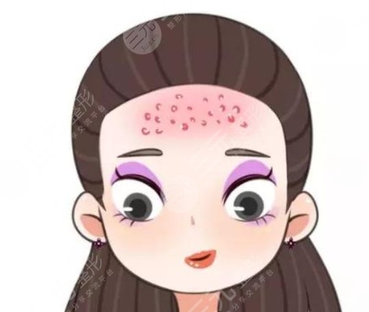 額頭長(zhǎng)痘痘