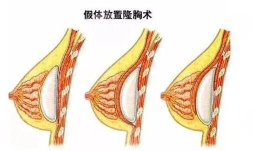 韓國蓓拉假體的價格貴嗎？