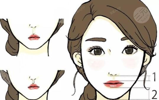 北京張曼醫(yī)生人中縮短手術(shù)之后有哪些注意事項呢?