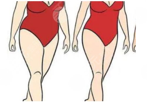 鄭州天后陳三群吸脂