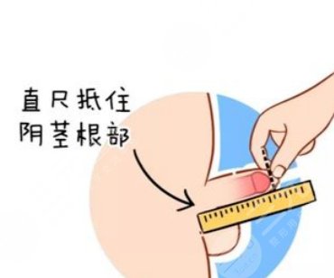 陰莖延長術(shù)