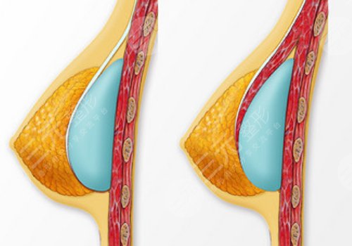 雙平面假體隆胸弊端優(yōu)缺點(diǎn)