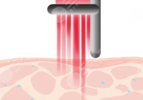 上海九院點(diǎn)陣激光醫(yī)生推薦