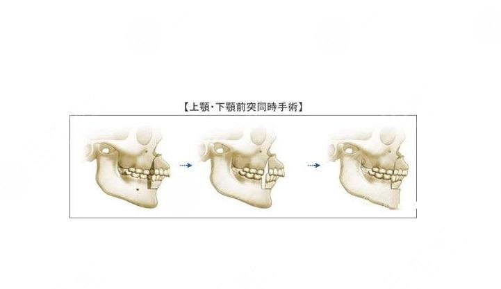 正頜手術(shù)風(fēng)險(xiǎn)大嗎