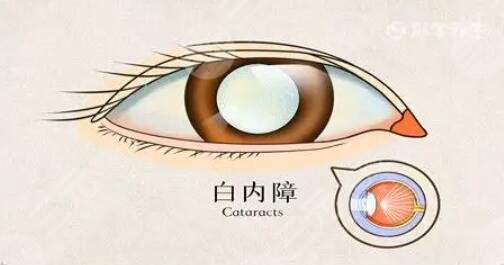 白內(nèi)障