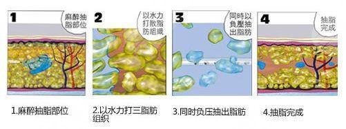 水動力吸脂和手術(shù)吸脂有什么區(qū)別