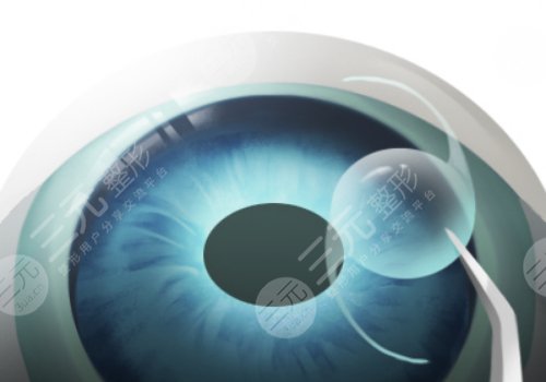 上海長(zhǎng)海醫(yī)院近視激光手術(shù)