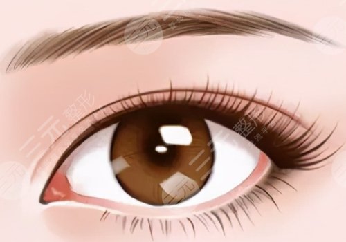 三眼皮怎么恢復(fù)雙眼皮