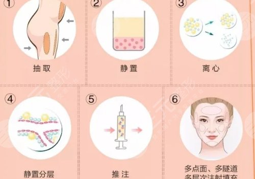 合肥韓美做脂肪填充額頭多少錢