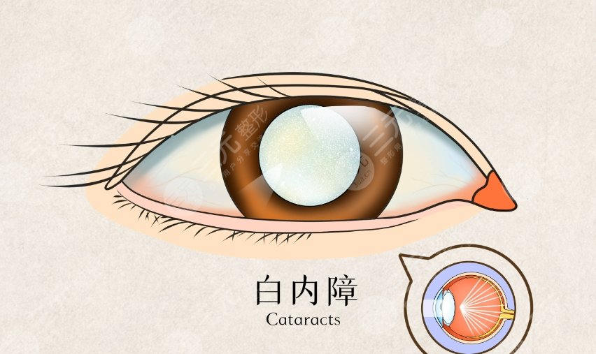白內(nèi)障