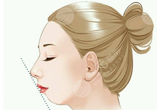 下頜角整形手術(shù)多少錢