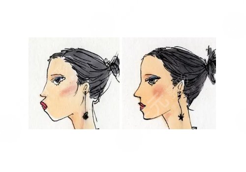 面部填充一般多少錢