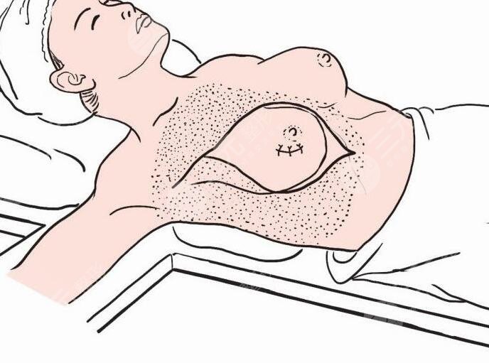 雙平面隆胸優(yōu)點