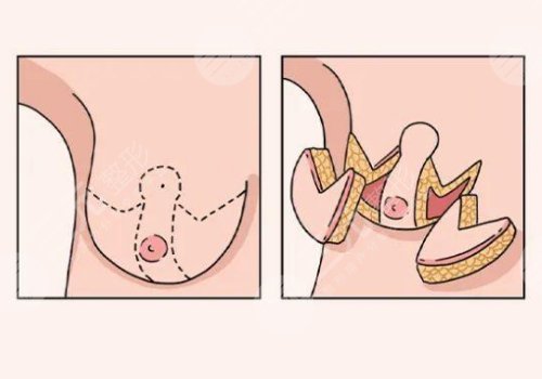 縮胸手術(shù)真實(shí)案例前后對(duì)比圖案例分享