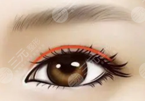 中關(guān)村敖健飛做雙眼皮怎么樣