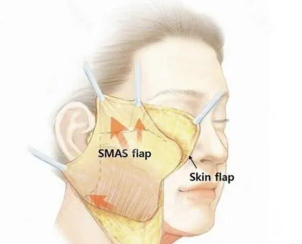 psv面部提升和拉皮的相同點