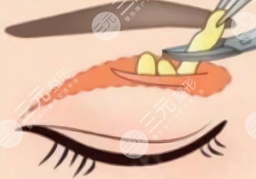 敖健飛做雙眼皮修復怎么樣