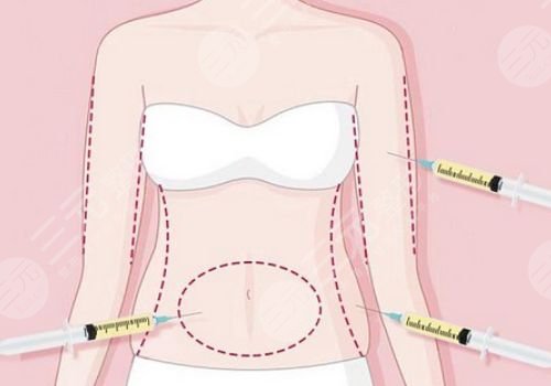 上海九院抽脂修復(fù)醫(yī)生