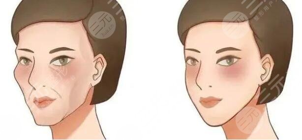 劉文先醫(yī)生玻尿酸注射填充太陽穴案例