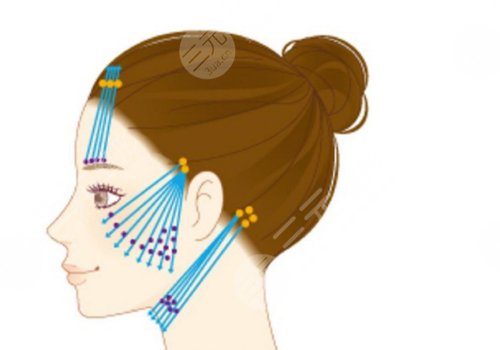 人工韌帶提升面部下垂安全嗎