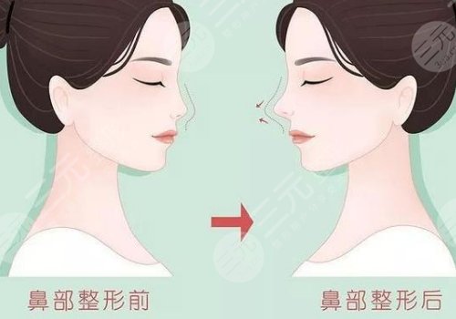 上海第九醫(yī)院隆鼻前后對比