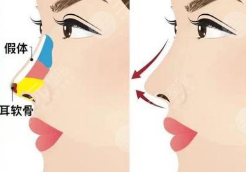 上海第九醫(yī)院隆鼻前后對比