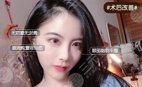 重慶第四人民醫(yī)院雙眼皮案例