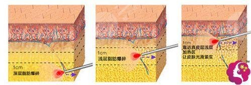 北京孫波醫(yī)生吸脂瘦小腿案例