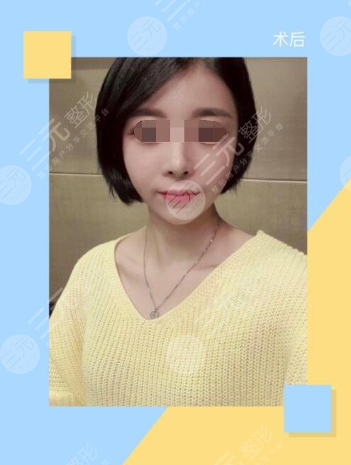 做自體脂肪豐額頭手術一個月以后