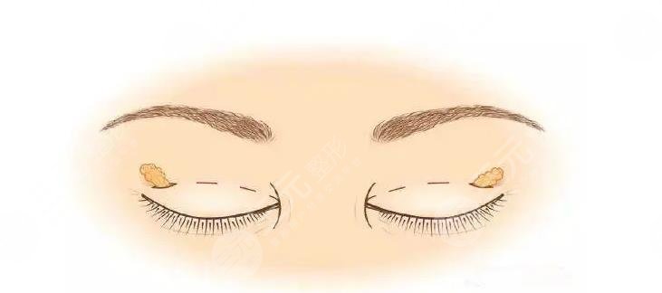 北京積水潭醫(yī)院劉巖和楊凱哪個擅長?做雙眼皮手術