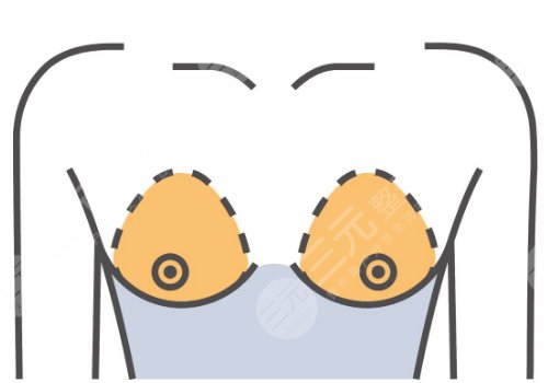 假體隆胸什么牌子好