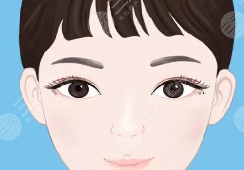 孫曉琦醫(yī)生的雙眼皮做的怎么樣